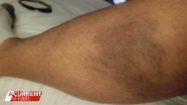 A bruise on Ben Murphy's leg.