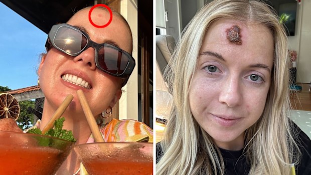The pink spot on Rachael's head turned out to be skin cancer. Topical chemotherapy left her with a large wound in its place.