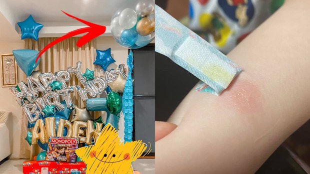 Left: Balloon arrangement, Right: burn on arm