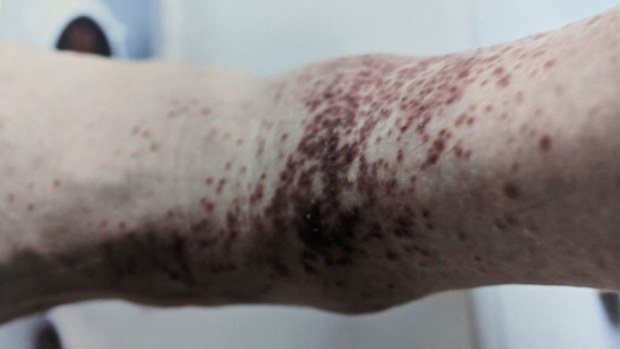 Howard Gorrell said he is bitten by dozens of ticks whenever he ventures outside.