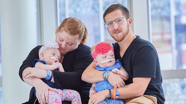 How twins once joined at the head are doing one year on