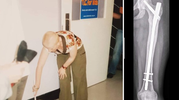 Casey had an intramedullary rod inserted in her leg 17 years after her cancer diagnosis