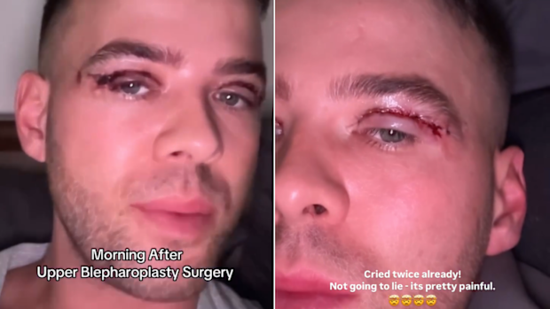 MAFS NZ Samuel Levi eyelid surgery