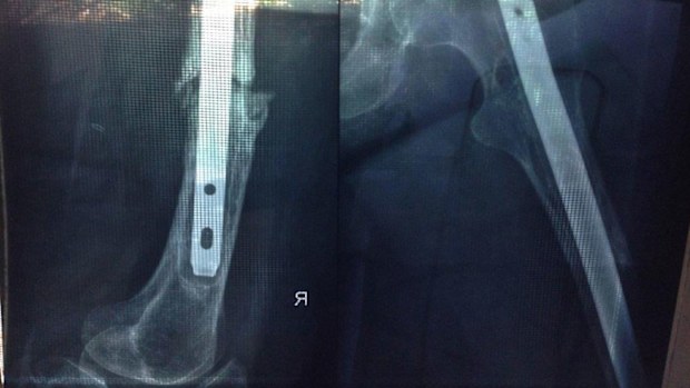 X-rays of Christine's right leg bone before her many surgeries.