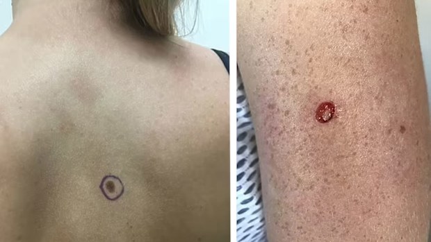 Skin Cancer: Blood tests could soon help diagnose skin cancer | Nine.com.au