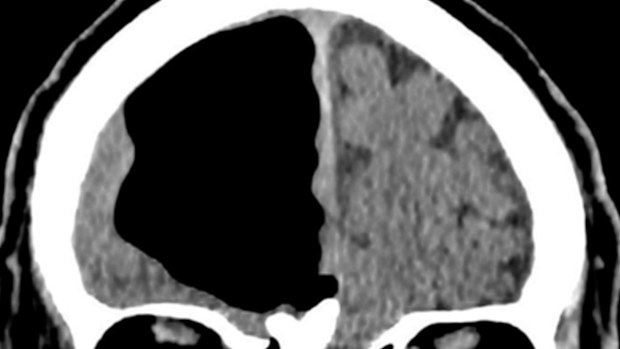 An Irish man was found with a nine-centimetre air cavity in his skull after feeling uneasy and taking a few falls. (BMJ Case Reports)