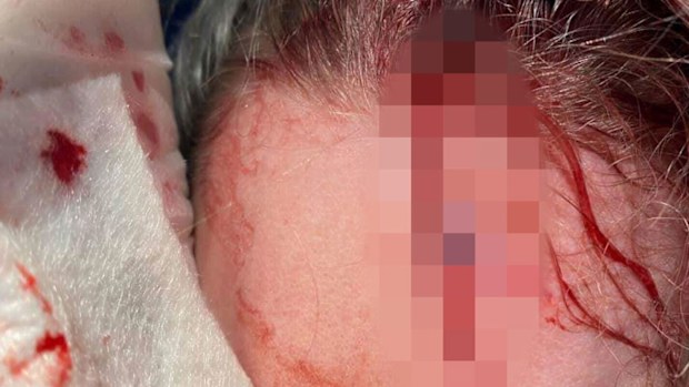 The specialist nurse's scalp was split to her skull during the attack and she needed 16 stitches.