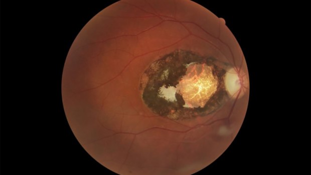 One in 150 Australians have retinal scars caused by the Toxoplasma parasite.