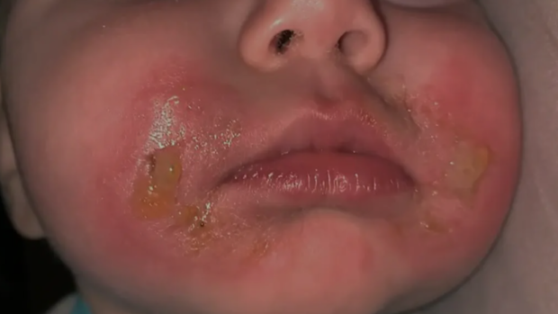 Mum Reanna documented the little girl's face after getting 'margarita burns'