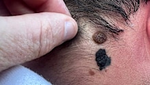 A﻿ tradies life has been saved after the man who hired him spotted a suspicious looking mole, which turned out to be skin cancer.