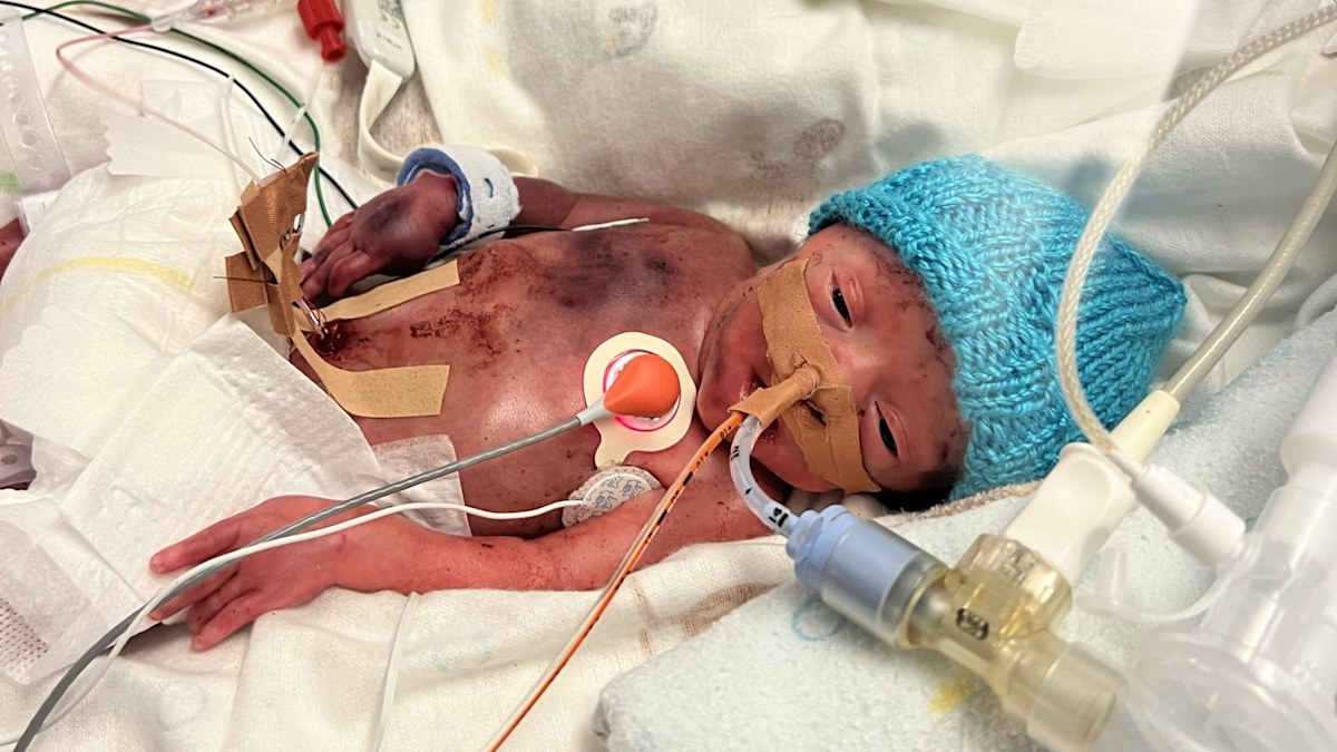 Premature Birth: Tough choice faced by parents of 'miracle baby' born ...