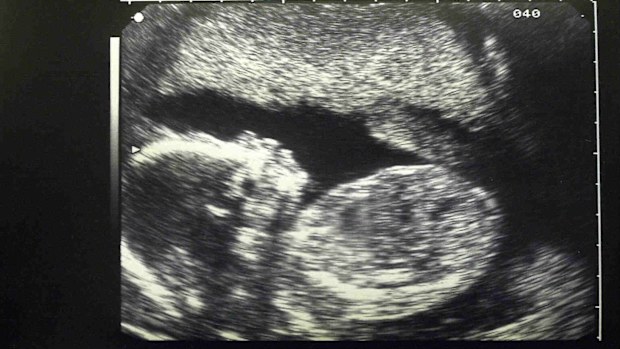 A pre-natal ultrasound showing a baby in the mothers womb. (Photo by Jeff Overs/BBC News & Current Affairs via Getty Images)