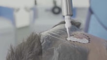Experts say the outcomes are similar to surgery and better than topical medications.