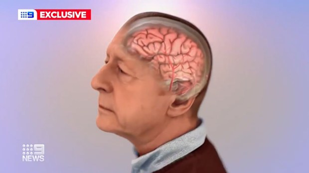 Sydney clinic trialling treatment for early Alzheimer's disease