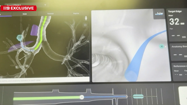 Lung cancer: 'Game changer' device could hold key to early detection ...