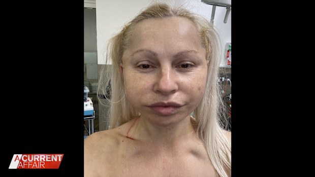 Jackie after her surgery.