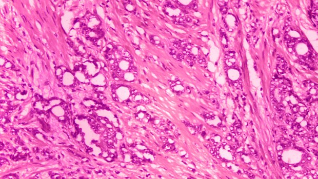This 1974 microscope image made available by the US Centers for Disease Control and Prevention shows changes in cells indicative of adenocarcinoma of the prostate. Some doctors say it's time to rename low-grade prostate cancer to eliminate the alarming C word