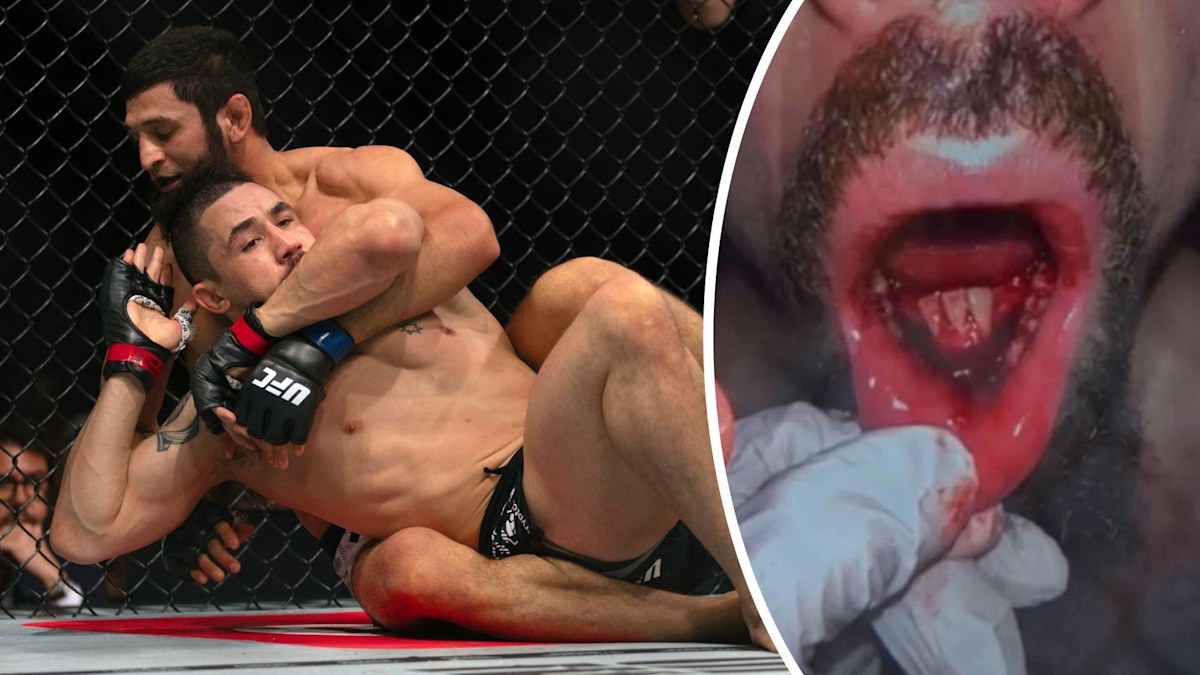 UFC news 2024: Robert Whittaker reveals teeth removal after gruesome ...