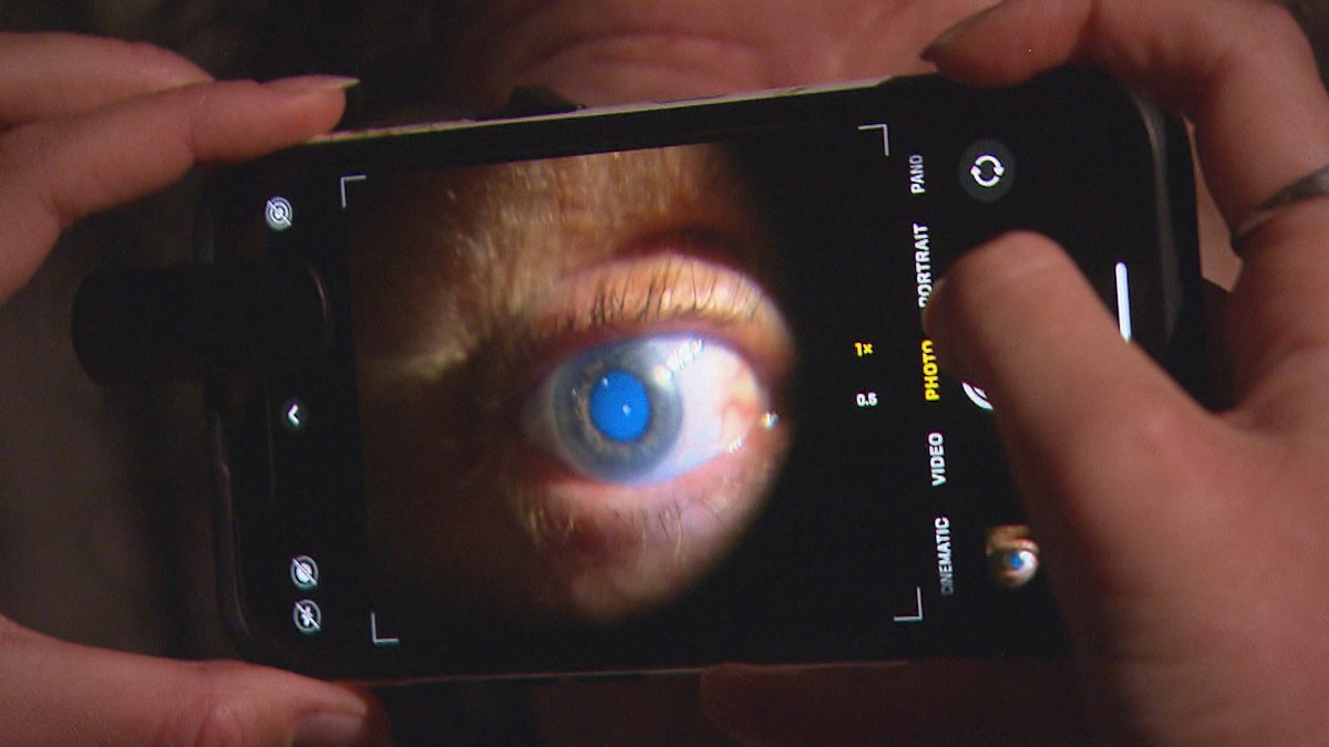 Sydney hospital testing phone gadget to help detect skin cancer risk ...