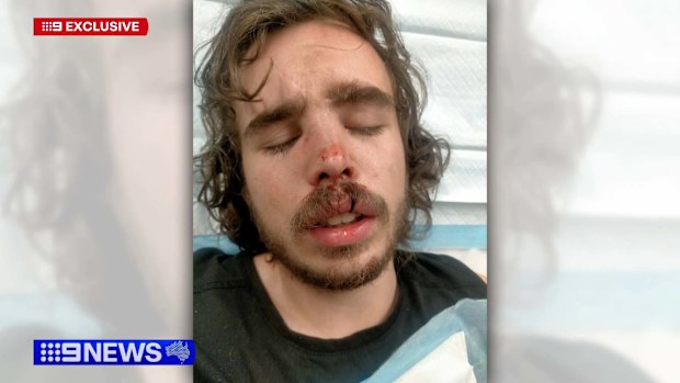 A Melbourne tradie has been left with serious injuries to his face after being attacked by an e-scooter rider in a road rage incident.Tyler Macaloney was driving home from his panel beating job in Parkville on Friday when he was confronted by a man who was weaving in and out of traffic.