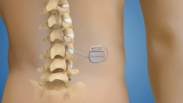 It is surgically implanted about 2cm under the skin. (9NEWS)