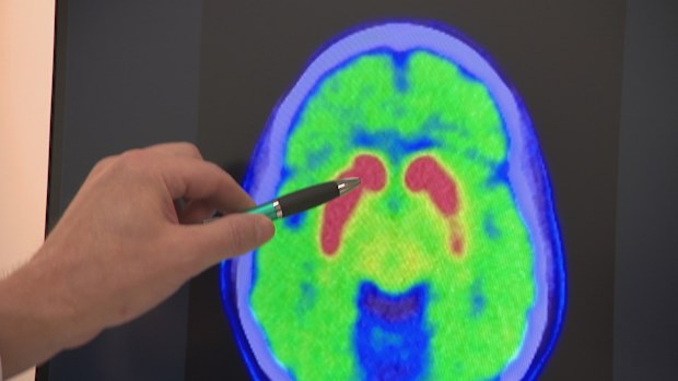 Parkinsons trial