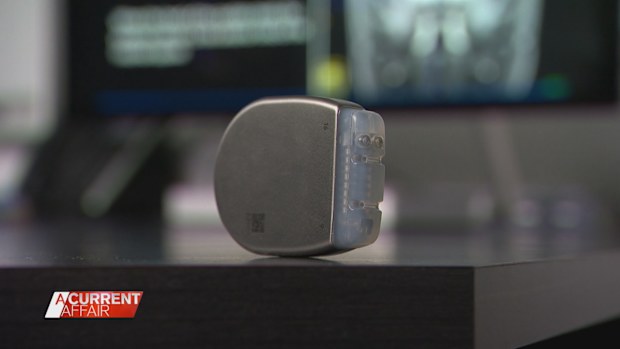 New study looks into treating OCD with pacemakers