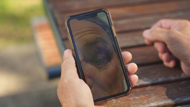 Ian said he was left with a bruised face, busted eye and bleeding on the brain.