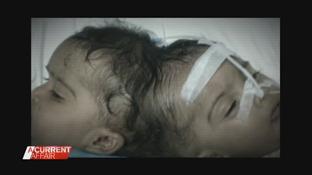 Conjoined twins separated in Melbourne 16 years ago living 'wonderful' lives