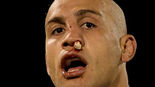 CANBERRA, AUSTRALIA - APRIL 14: Blake Ferguson of the Eels has a broken nose during the Round 5 Canberra Raiders and Parramatta Eels match at GIO Stadium on April 14, 2019 in Canberra, Australia. (Photo by Tracey Nearmy/Getty Images)