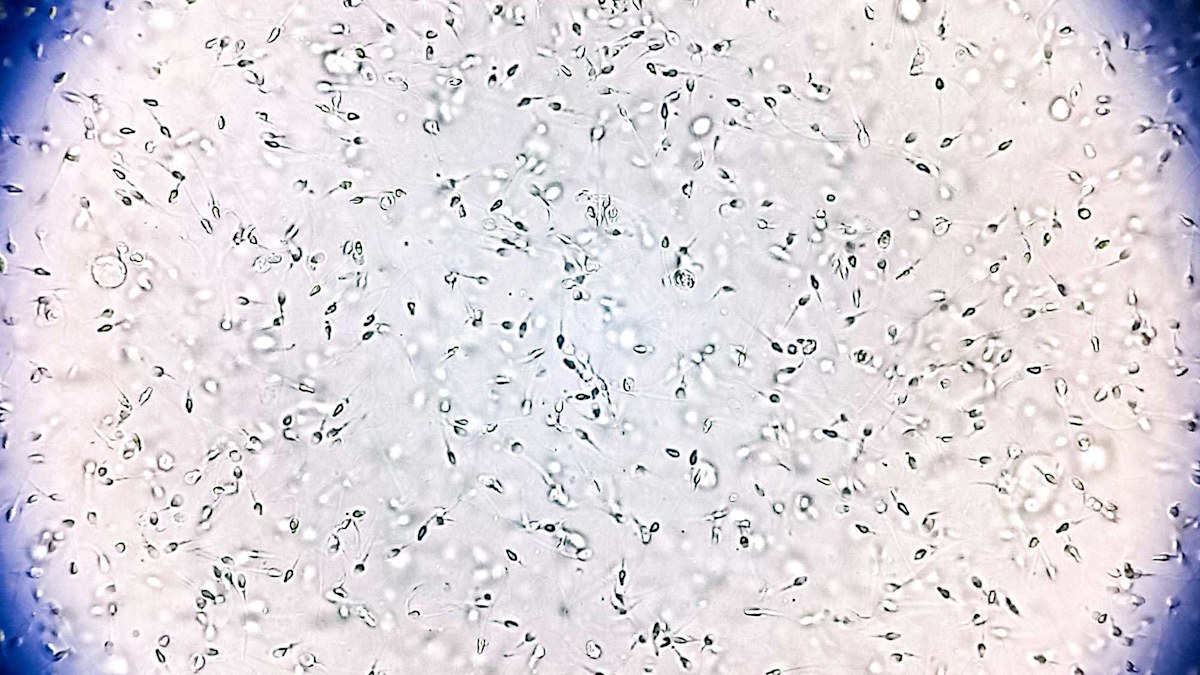 Sperm donor with rare genetic mutation fathered 67 children. Ten now have cancer