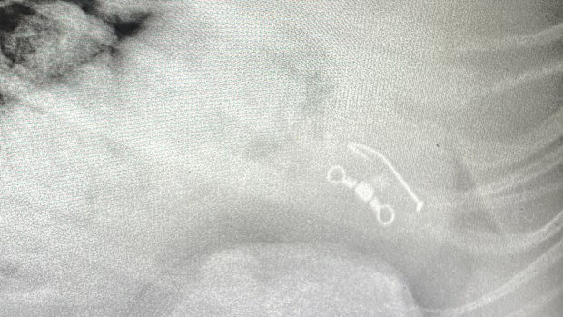 An x-ray shows the fishing hook in Ripley's stomach.