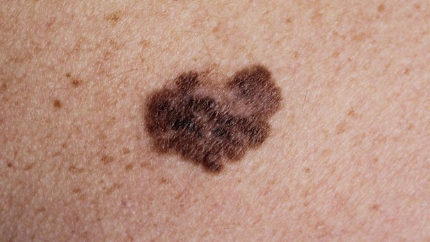 melanoma