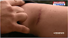 Surgery has repaired the muscle but Kate Jessop says the ongoing nerve pain and emotional trauma still impacts her day to day life. 