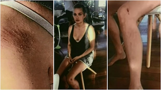 Alexandra Ivkovic had grazes on her shoulder and legs after her fiance Dylan Walker allegedly pulled her hair while she was holding her son.