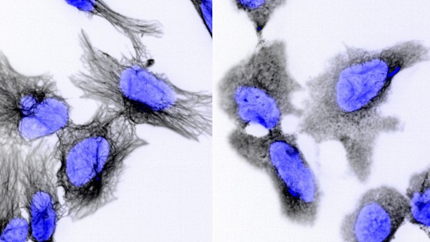 Neuroblastoma is a deadly cancer that can affect children as young as two-years-old. A new study by the Garvan Institute may have found a drug that can help cure it.