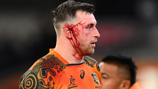 Nick Frost of the Wallabies with his ear injury at the MCG.