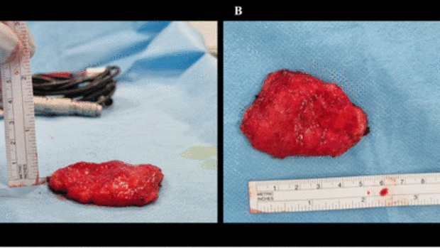 Breakdance tumour