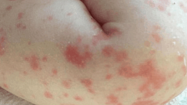 The baby's skin after she contracted sepsis. (Canadian Medical Association Journal)