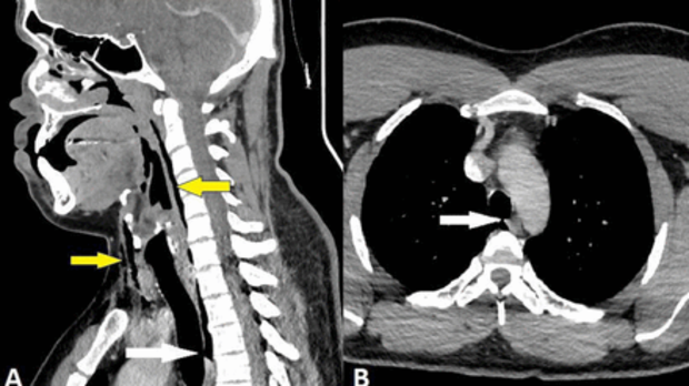 Man tears windpipe by holding in sneeze