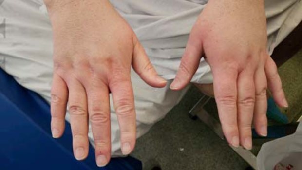 Man diagnosed with scurvy amid cost of living crisis, weight loss surgery