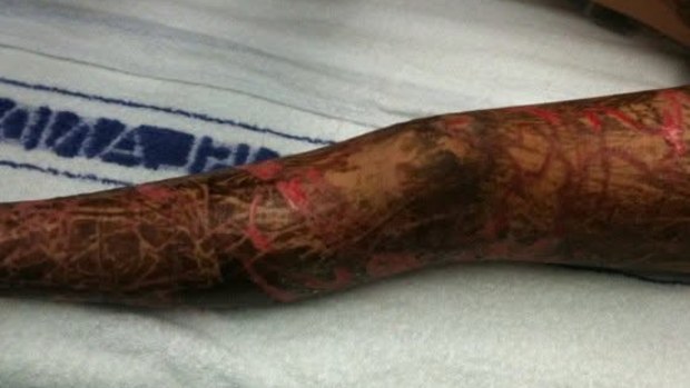 Rachael Shardlow was a victim of a severe box jellyfish sting when she was a child.