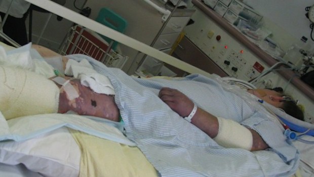 Mel Groenewold had the tell-tale purple rash on her skin.