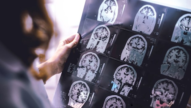 An MRI scan of a dementia patient
