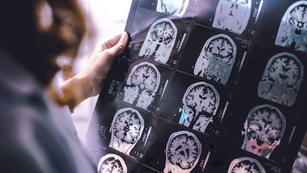 Dementia is one of the leading causes of death in Australia but a new finding could revolutionise detection and treatment. 