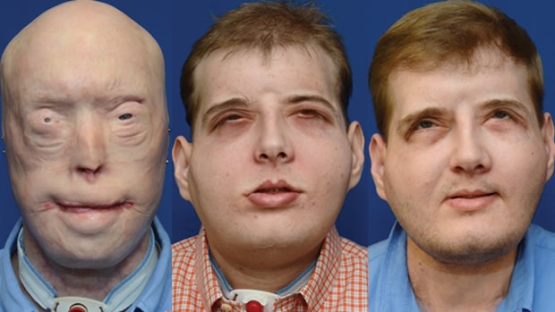 Mississippi firefighter Patrick Hardison underwent a full face transplant after being burnt in the line of duty in 2001. From left to right: Pre-operative in August 2014, Post-operative in November 2015, Post-operative in August 2016.