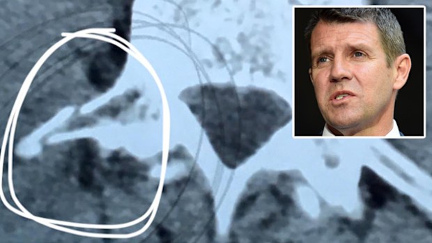 An X-ray of NSW Premier Mike Baird's back, showing a fractured vertebrae. 