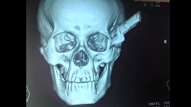 Taxi driver Juacelo Nunes de Oliveira had a knife lodged in his skull.