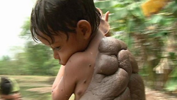 Didier Montalvo who had a 'turtle shell' like mole on his back has now a new lease on life after having it removed three years ago. (ITV)