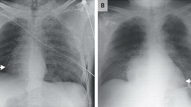 An X-ray showing the heart following the crash (left) and after it moved back into place (right). (New England Journal of Medicine)